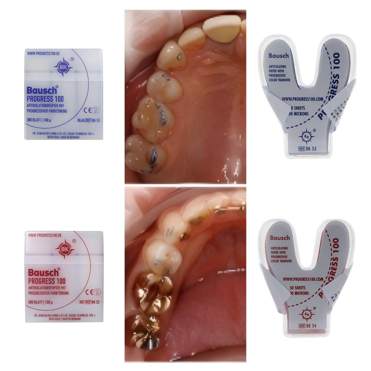 Bausch BK51 BK52 BK53 BK54 Den - Bite Indicator บทวิจารณ์และราคา